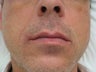 Radiesse for Nasolabial folds