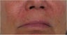 Juvederm to nasolabial folds