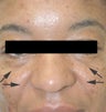 Treatment for Laugh lines