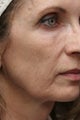 Micro Botulinum Toxin Injection