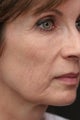 Micro Botulinum Toxin Injection