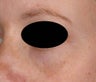 Bue veins under eyes