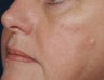 Yag laser
