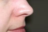 Yag laser