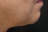 GentleYag treatment for skin tightening