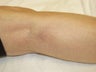 Laser vein removal on legs