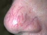 Vein treatment