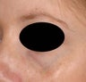 Bue veins under eyes