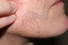Yag laser