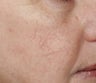 Yag laser