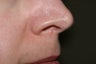 Yag laser