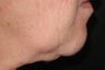 GentleYag treatment for skin tightening