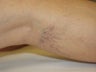 Laser vein removal on legs