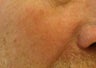 Nd:Yag Laser for telangiectasia