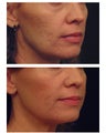 YAG Laser Skin Tightening