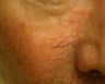 Nd:Yag Laser for telangiectasia