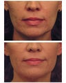 YAG Laser Skin Tightening