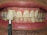 Zoom Whitening