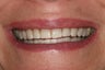 ZOOM whitening
