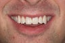 Zoom Whitening