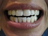Zoom Teeth Whitening