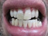 Zoom Teeth Whitening