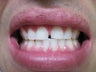 Zoom Teeth Whitening