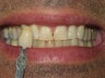 Zoom Whitening