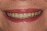 ZOOM whitening