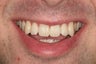 Zoom Whitening
