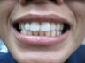 Zoom Teeth Whitening