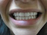 Zoom Teeth Whitening