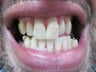 Zoom Teeth Whitening