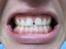 Zoom Teeth Whitening