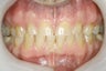 Bites can improve from a full restoration