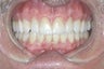 Bites can improve from a full restoration