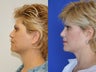 Ultherapy treatment full face