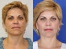 Ultherapy treatment full face