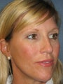 Brow Lift