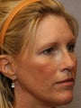Brow Lift