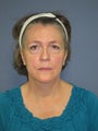 treatment of lower eyelid bags