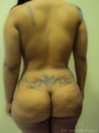 30 year old female treated for Brazilian Butt Lift