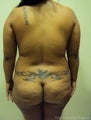 30 year old female treated for Brazilian Butt Lift
