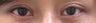 Bilateral Asian Blepharoplasty