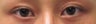 Bilateral Asian Blepharoplasty