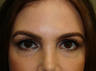Eyelid Surgery