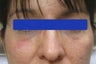 Undereye dark circles treated with filler