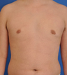 Male Breast Reduction