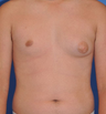 Male Breast Reduction