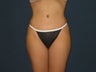 Tummy Tuck